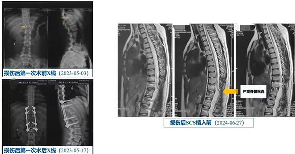 宣武有术｜时序脊髓电刺激联合外骨骼康复治疗脊髓损伤